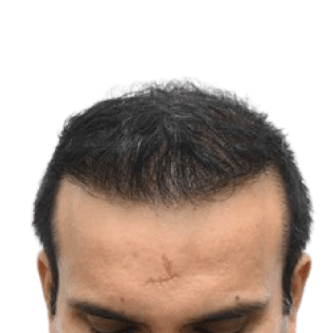 After Patient 3