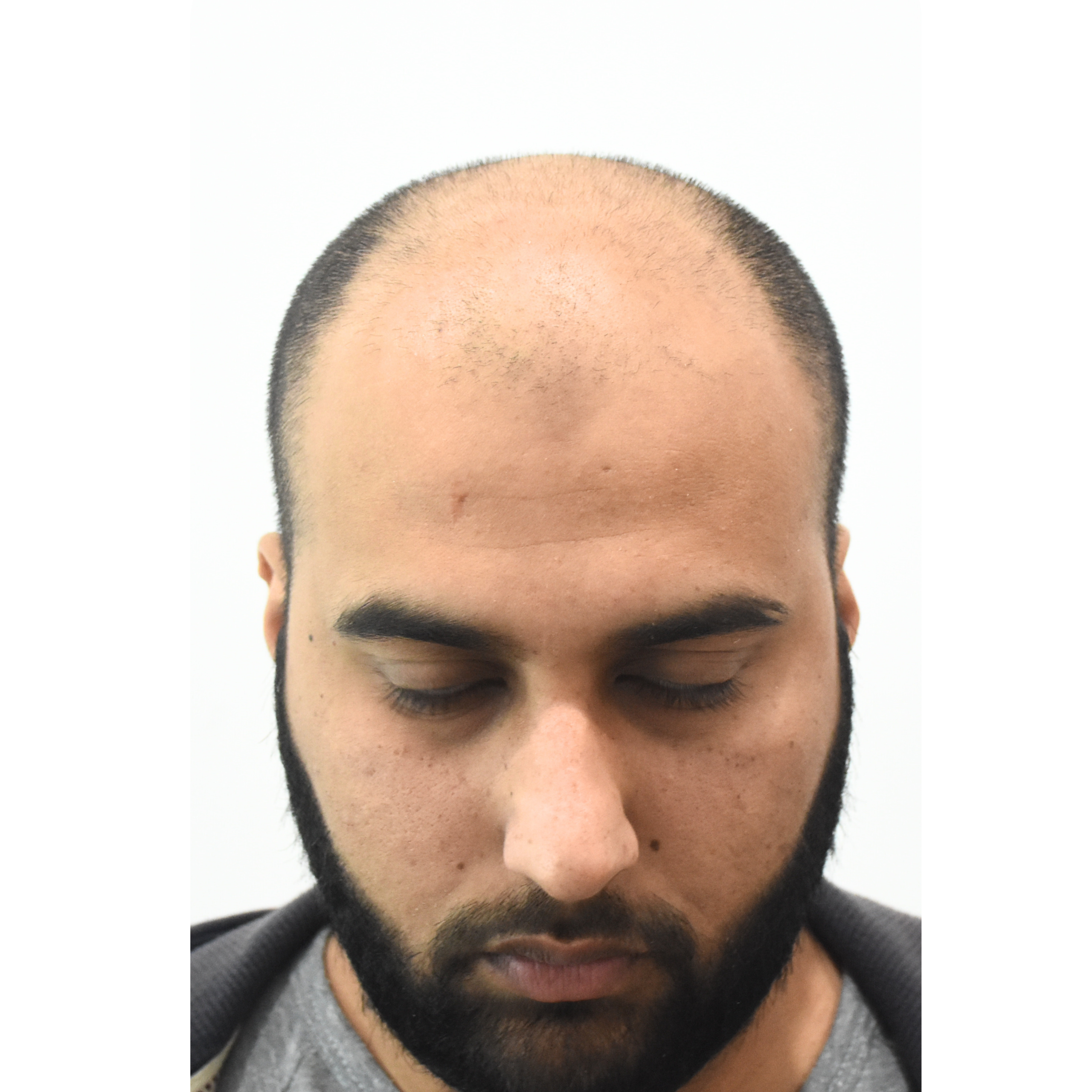 Ahmed before